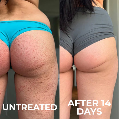 Advanced Triple-Acid Complex for Keratosis Pilaris