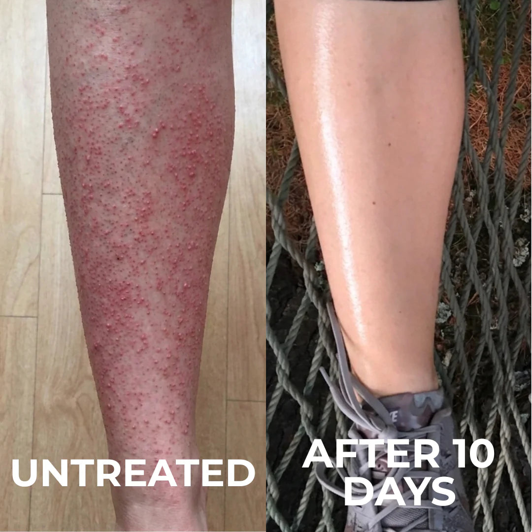 Advanced Triple-Acid Complex for Keratosis Pilaris
