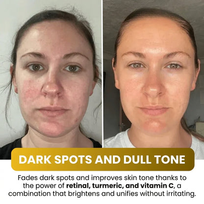Kojic Acid Turmeric Overnight Mask