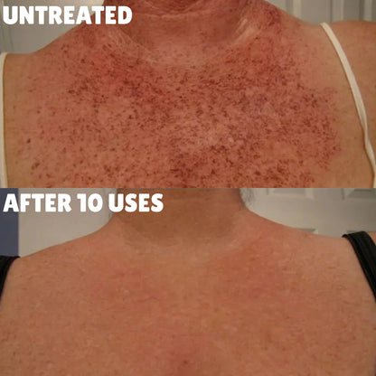 Advanced Triple-Acid Complex for Hyperpigmentation